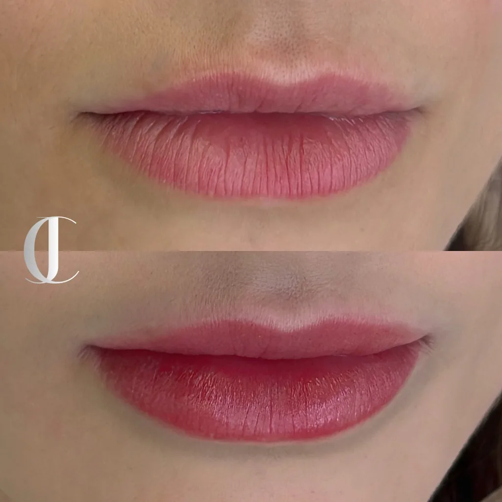 Antes e depois de micropigmentação labial