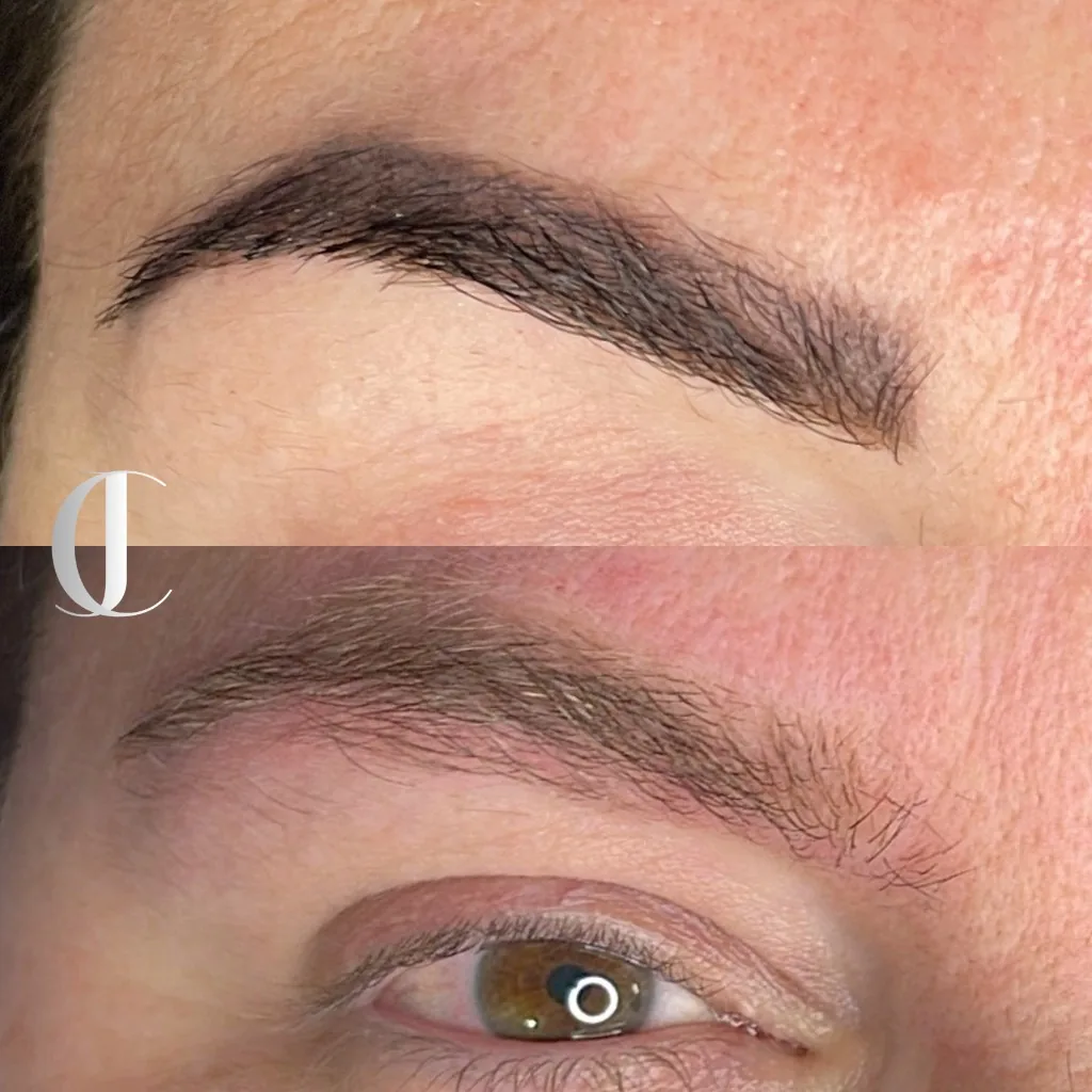 Antes e depois de remoção a laser de sobrancelha