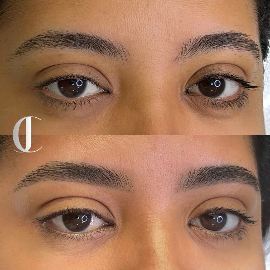 Antes e depois de micropigmentação de sobrancelha